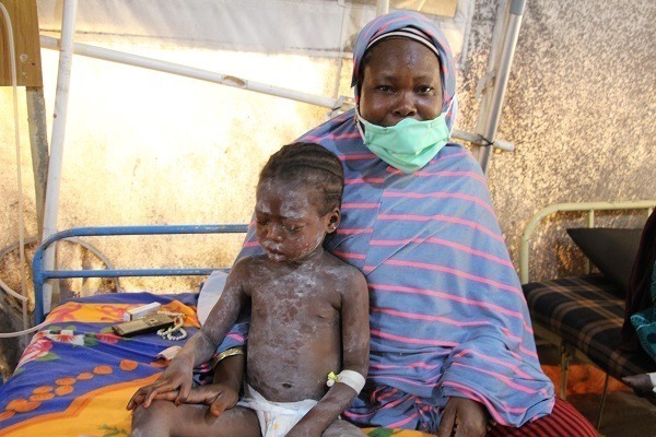 BORNO MEASLES OUTBREAK
