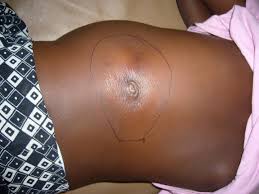 Adamawa Confirms Six Deaths from Suspected Buruli Ulcer Outbreak