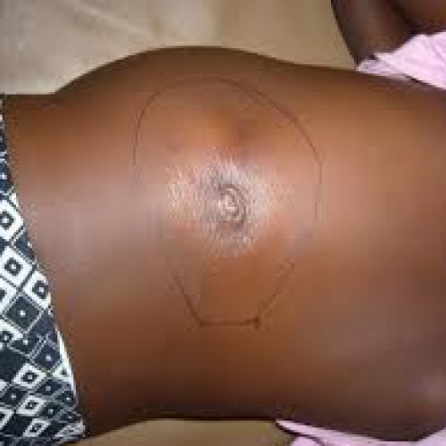 Adamawa Confirms Six Deaths from Suspected Buruli Ulcer Outbreak
