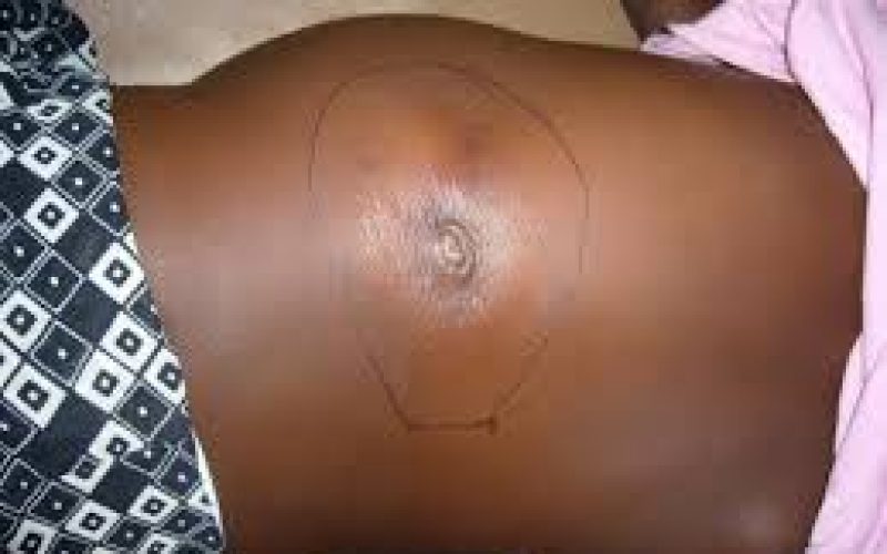 Adamawa Confirms Six Deaths from Suspected Buruli Ulcer Outbreak