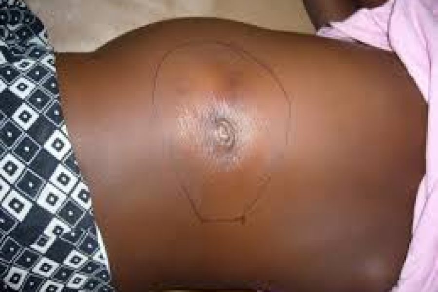 Adamawa Confirms Six Deaths from Suspected Buruli Ulcer Outbreak